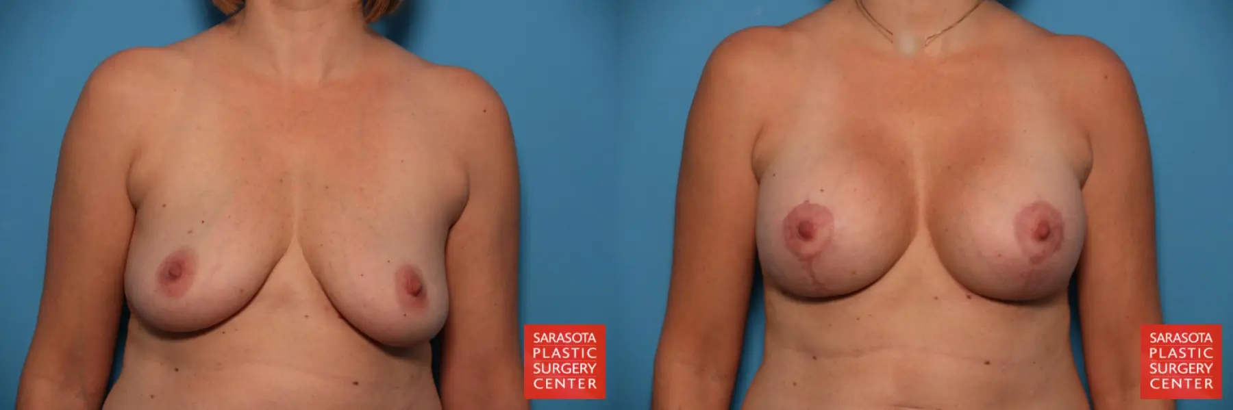 Breast Augmentation With Lift: Patient 8 - Before and After  