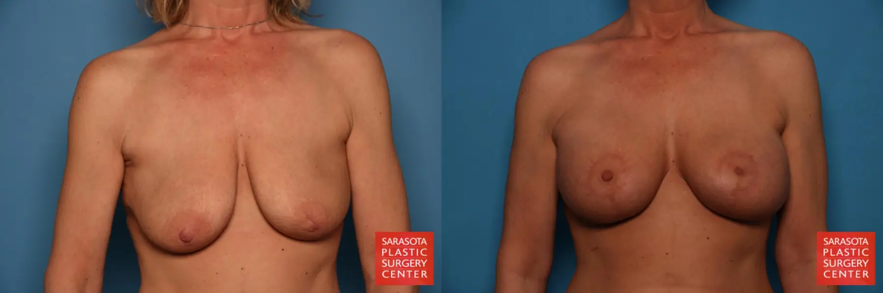 Breast Augmentation With Lift: Patient 9 - Before and After  