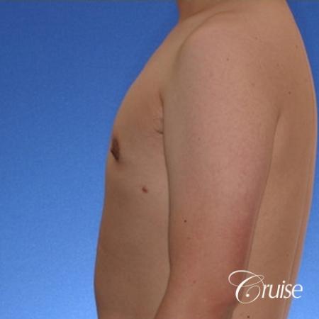 Gynecomastia Before After Gallery Patient 71