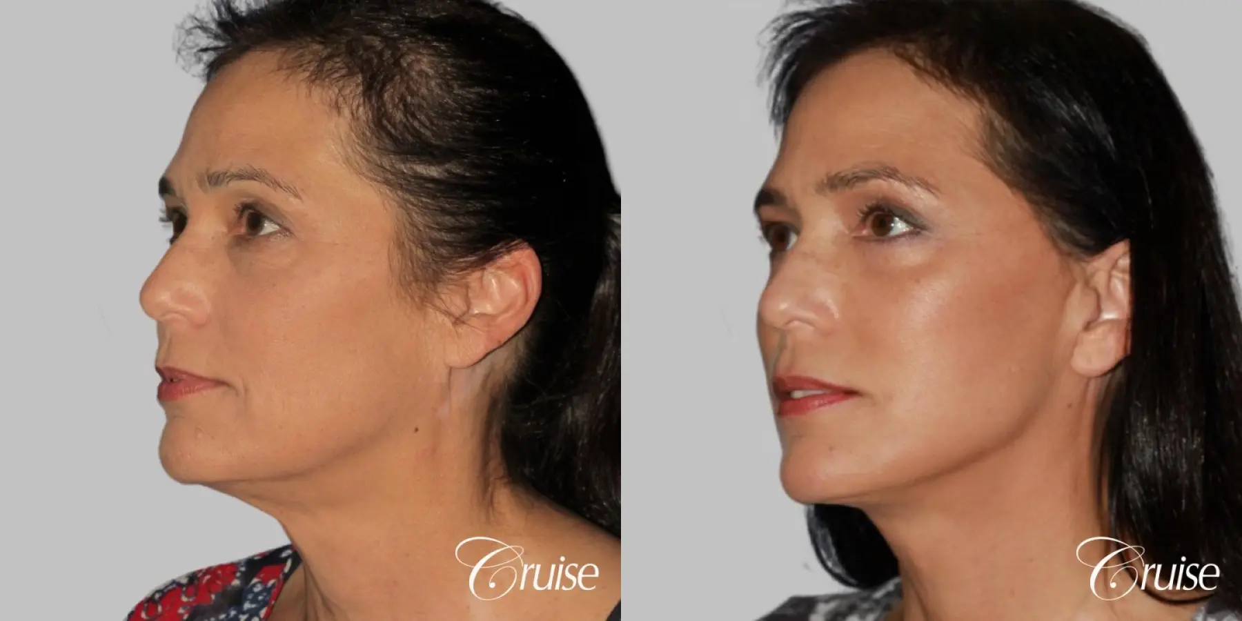 Facelift, Necklift, Lower Eyelid Surgery - Before and After 3