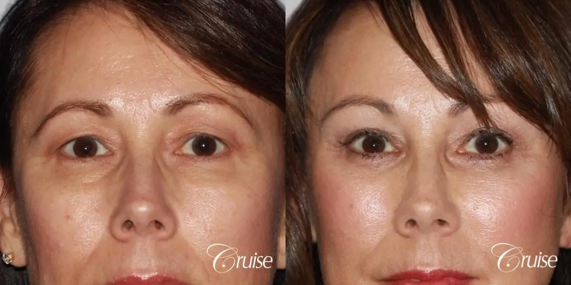 Female Facelift, Neck Midline Plication, Blepharoplasty, and Temple Lift Surgery - Before and After  