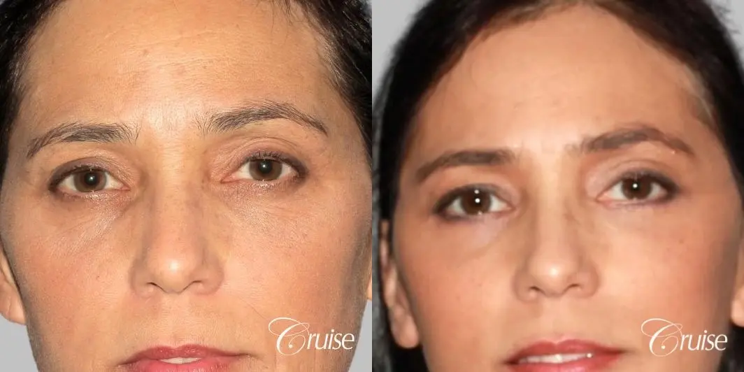 Facelift, Necklift, Lower Eyelid Surgery - Before and After 1