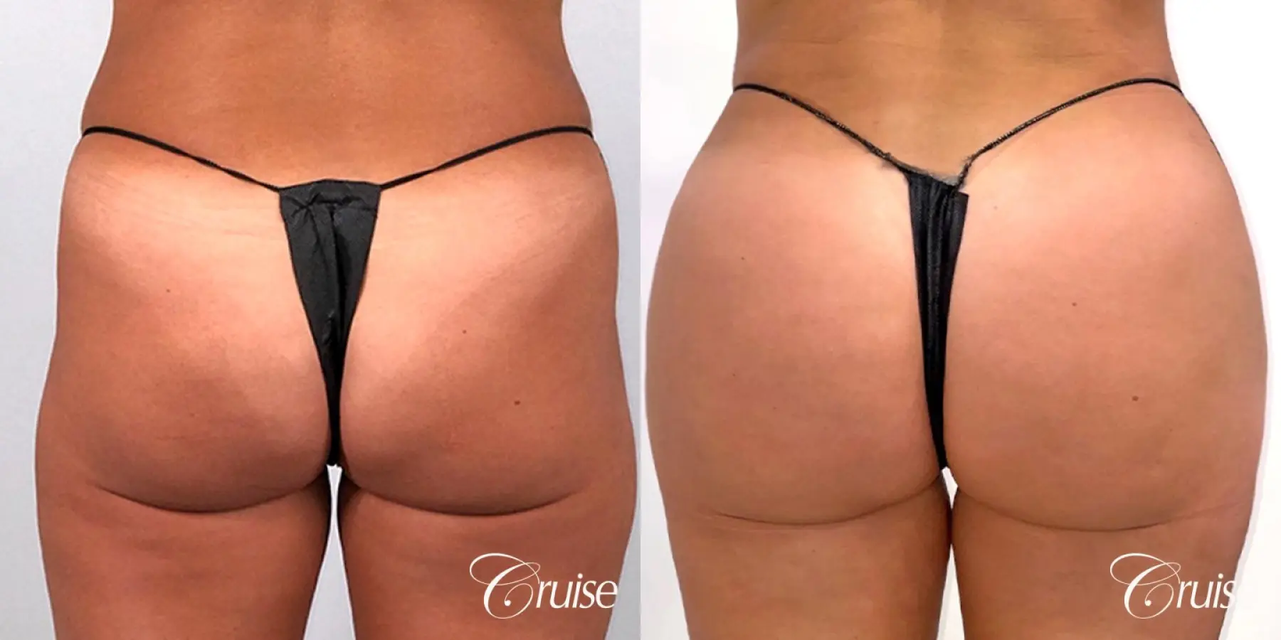 Brazilian Butt Lift with Liposuction to Stomach & Flanks