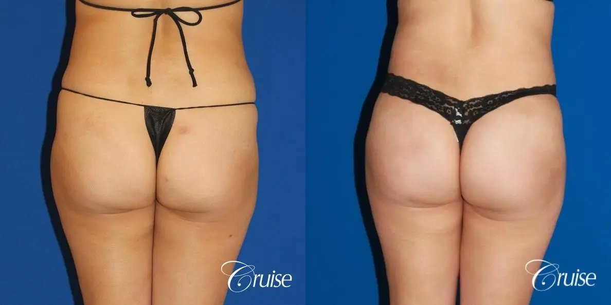 Brazilian Butt Lift Before & After Gallery: Patient 14