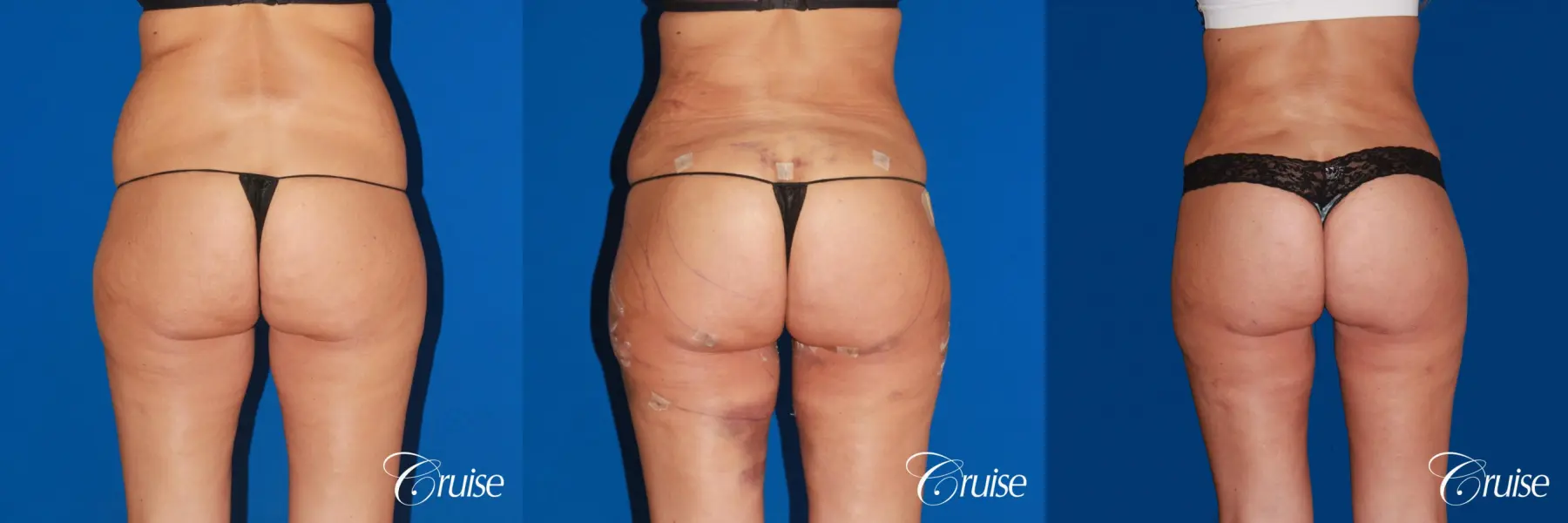 Brazilian Butt Lift Before & After Gallery: Patient 21