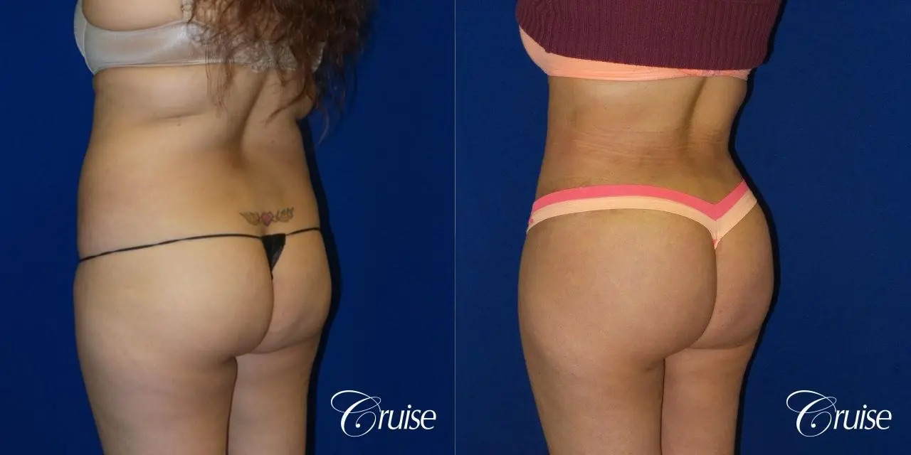 Brazilian Butt Lift Before & After Gallery: Patient 7