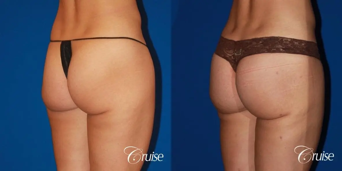Brazilian Butt Lift Before & After Gallery: Patient 11