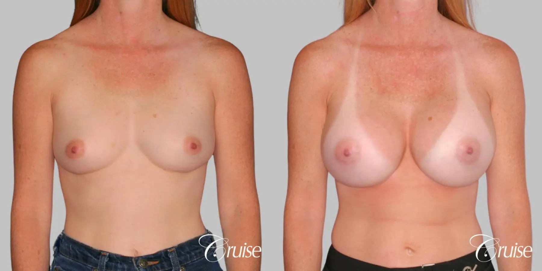 Breast Augmentation - Saline HP 580cc - Before and After 1