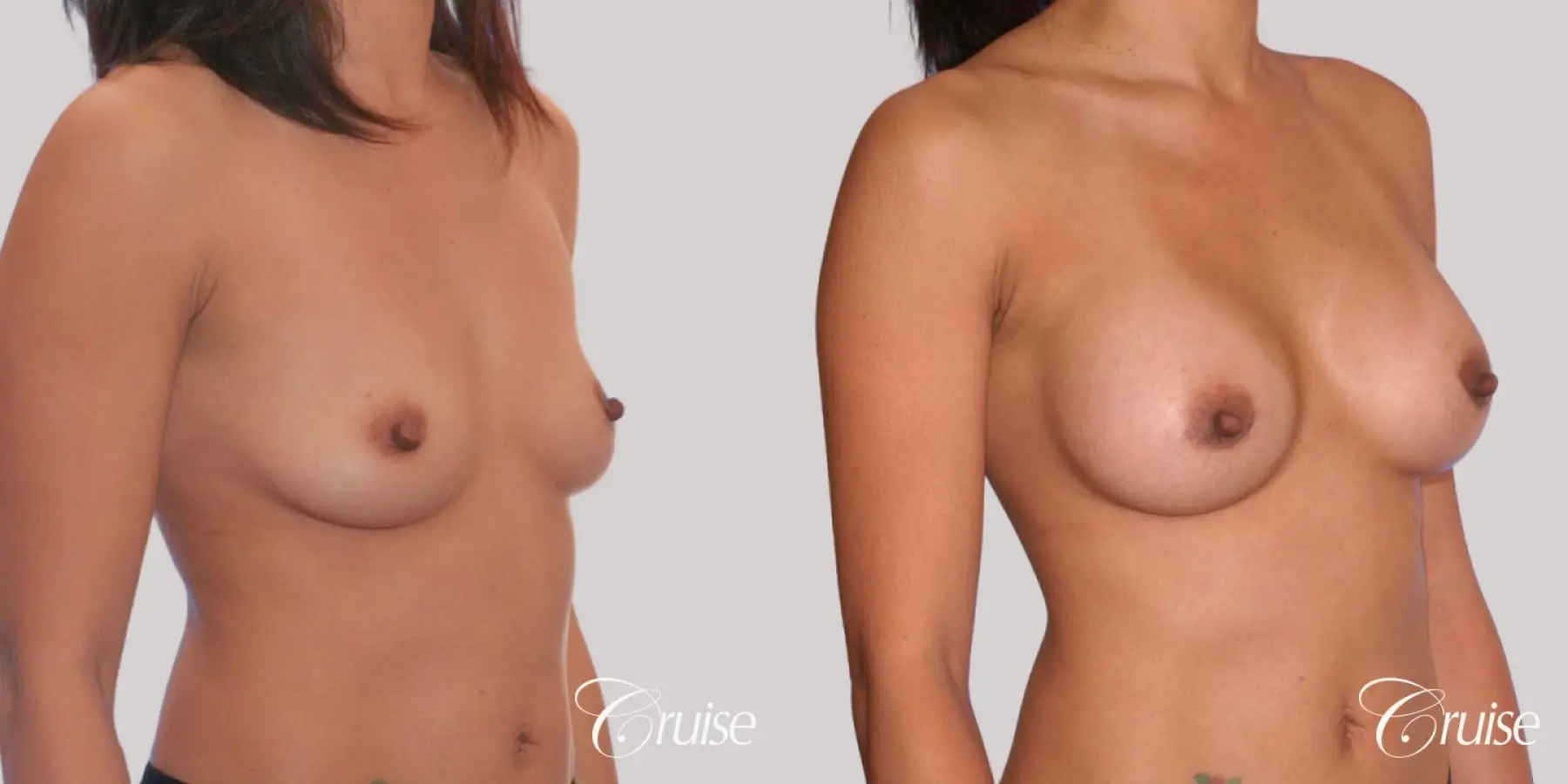 Breast Augmentation - Saline MP 255cc - Before and After 2