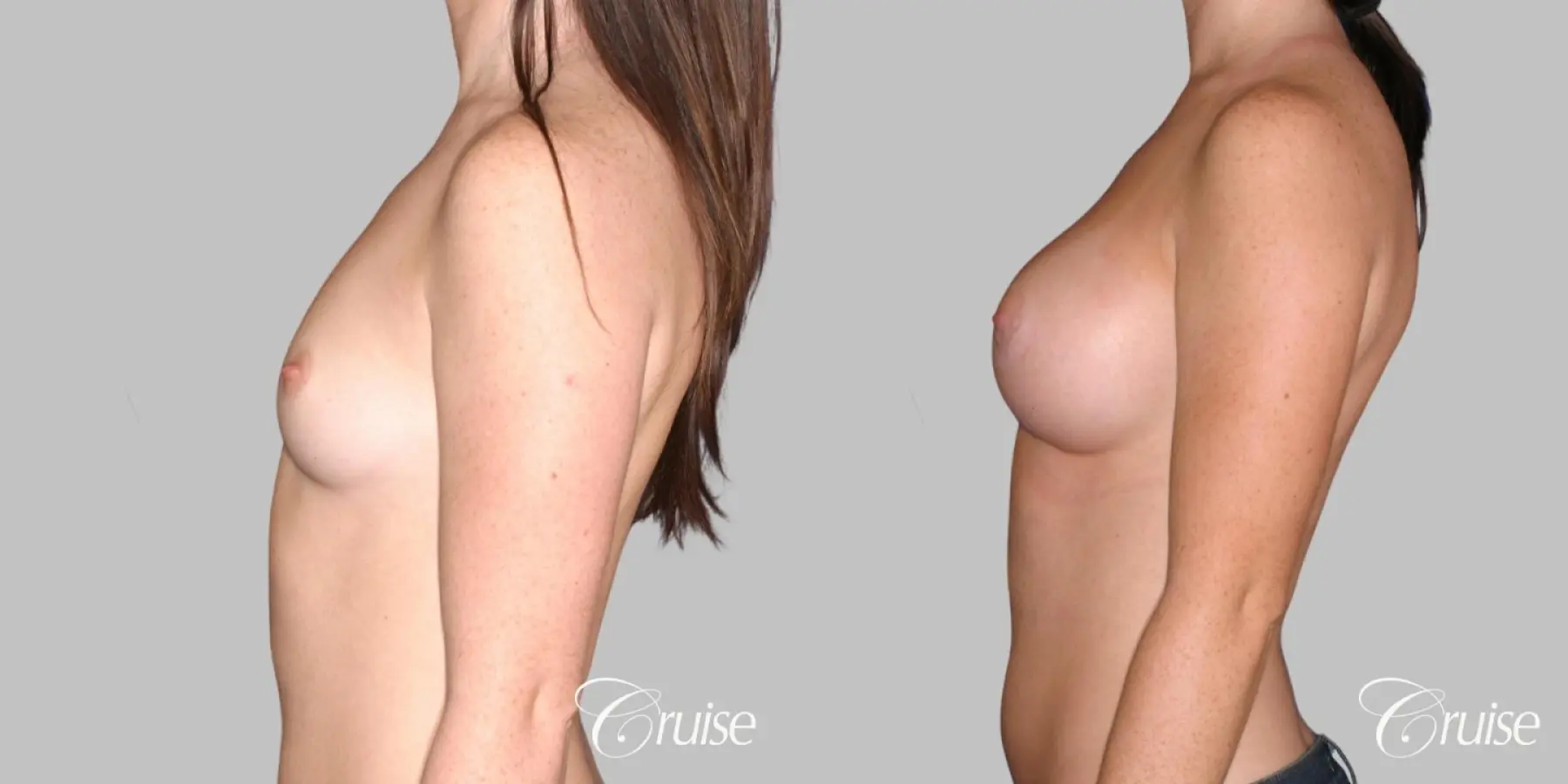 Breast Augmentation - Silicone HP 400cc - Before and After 3