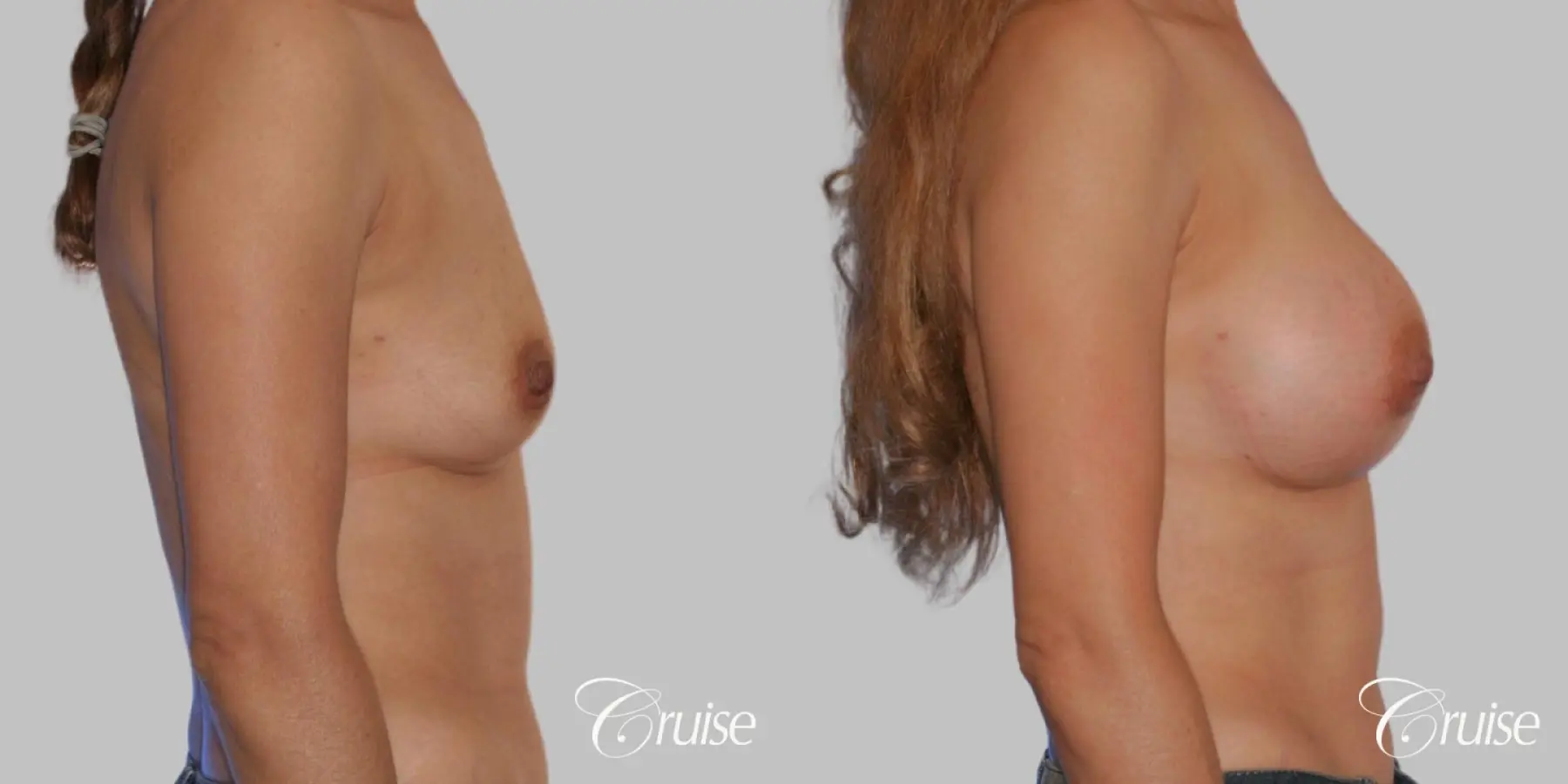 Breast Augmentation - Silicone HP 325cc - Before and After 3