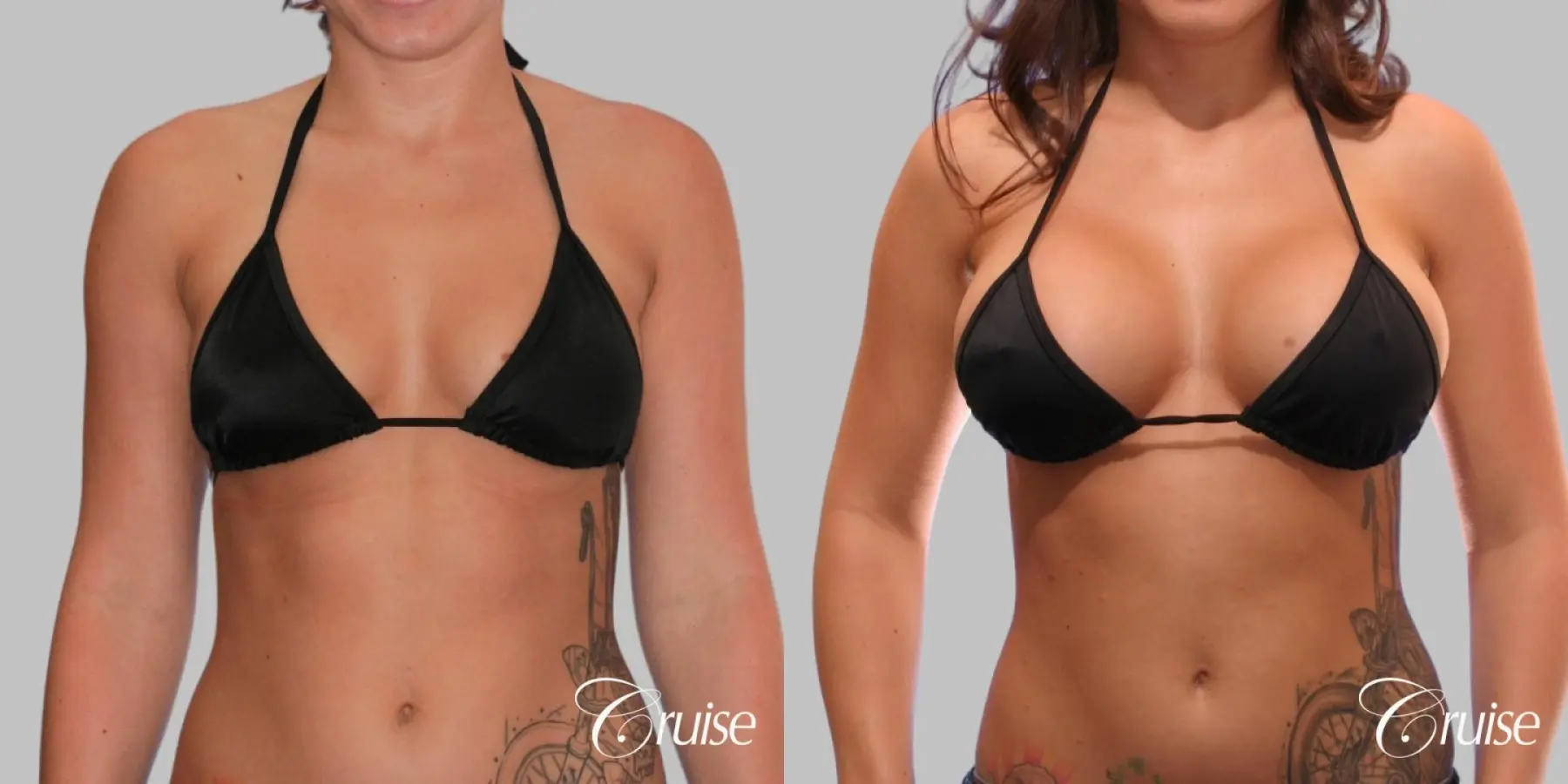 Breast Augmentation - Silicone HP 475cc - Before and After 4