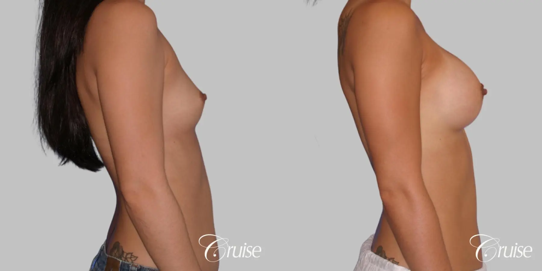 Breast Augmentation - Saline HP 280cc - Before and After 3