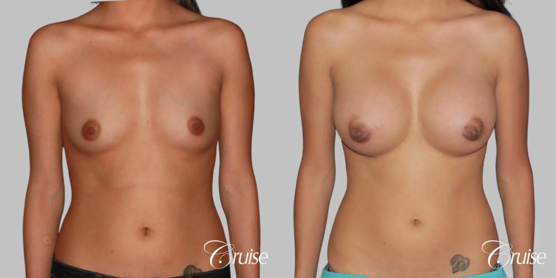 Breast Augmentation - Silicone MP 339cc - Before and After 1