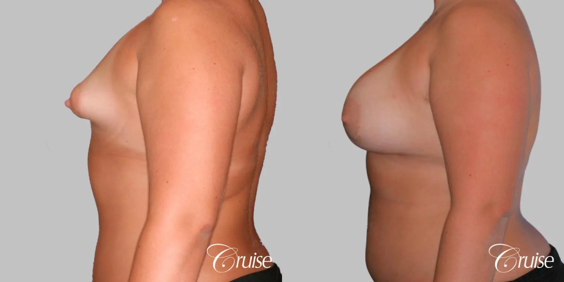 Breast Augmentation - Silicone HP 450cc - Before and After 2