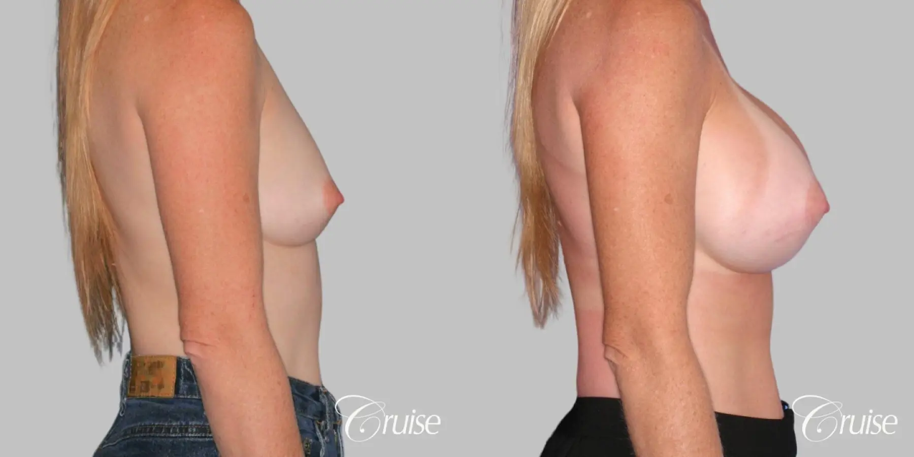 Breast Augmentation - Saline HP 580cc - Before and After 2