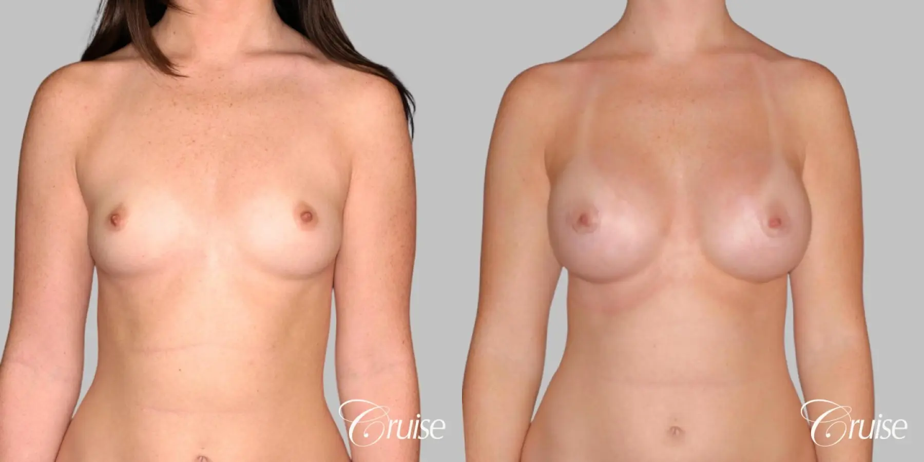 Breast Augmentation - Silicone HP 400cc - Before and After 1