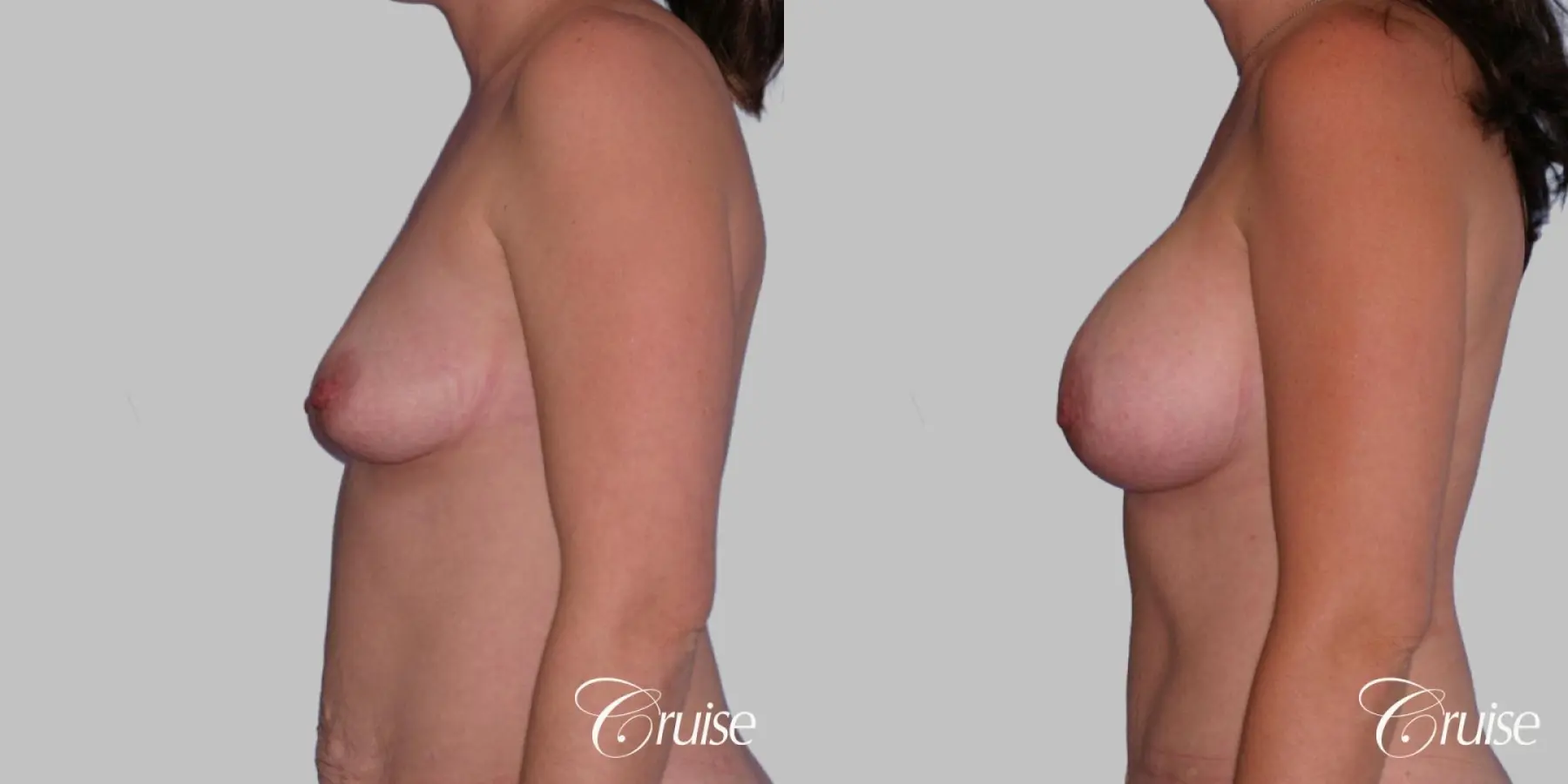 Breast Augmentation - Saline MP 360cc - Before and After 2