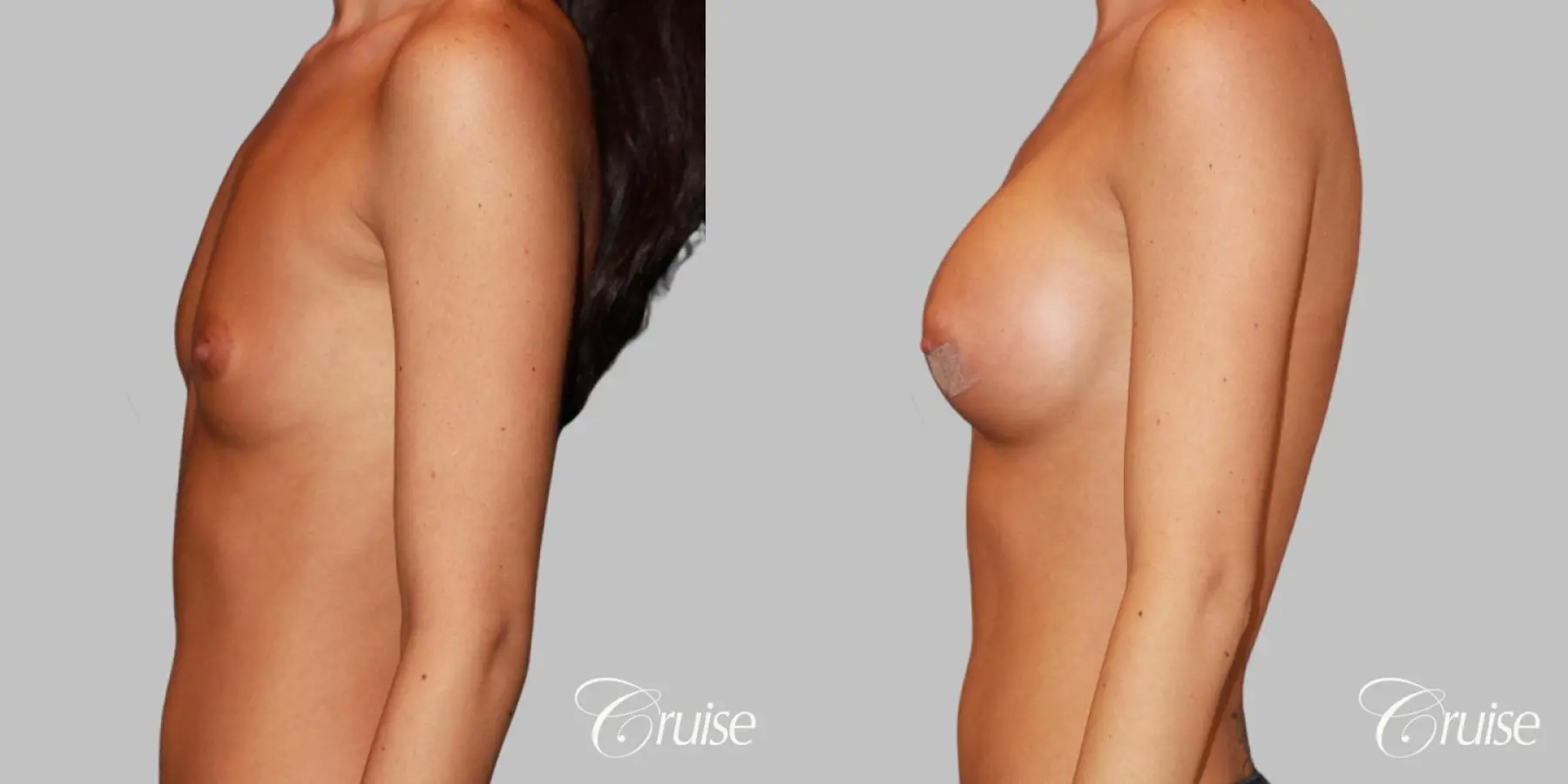 Breast Augmentation - Silicone MP 304cc - Before and After 3