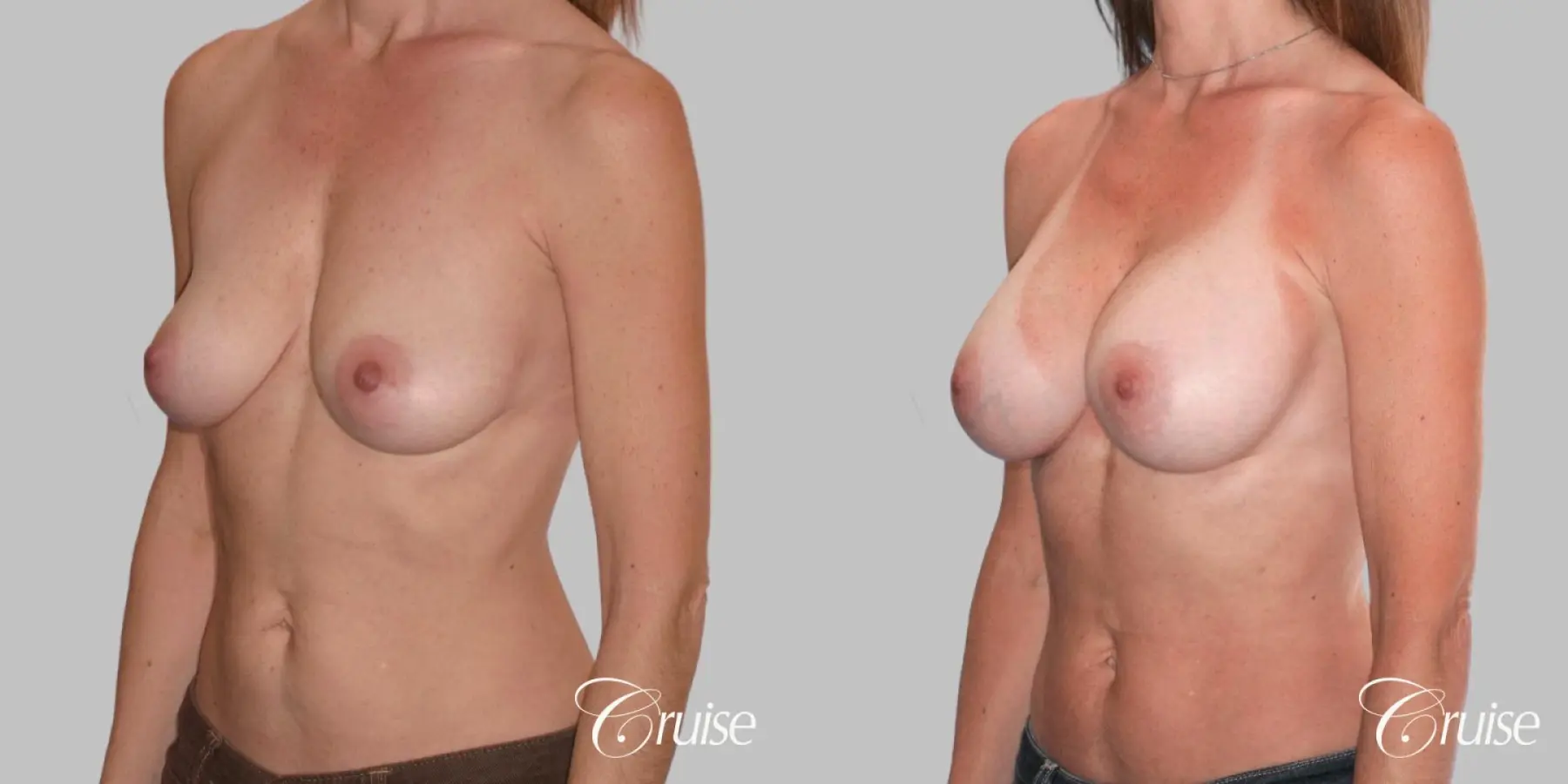 Breast Augmentation - Silicone MP 320cc - Before and After 2