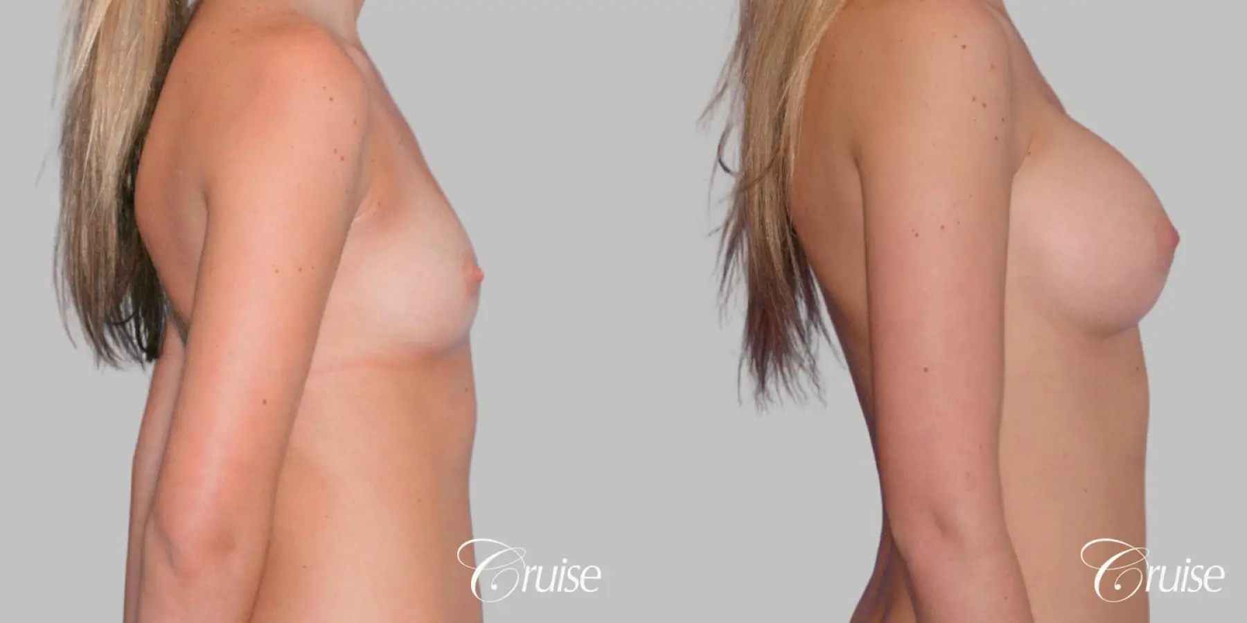 Breast Augmentation - Saline MP 440cc - Before and After 3