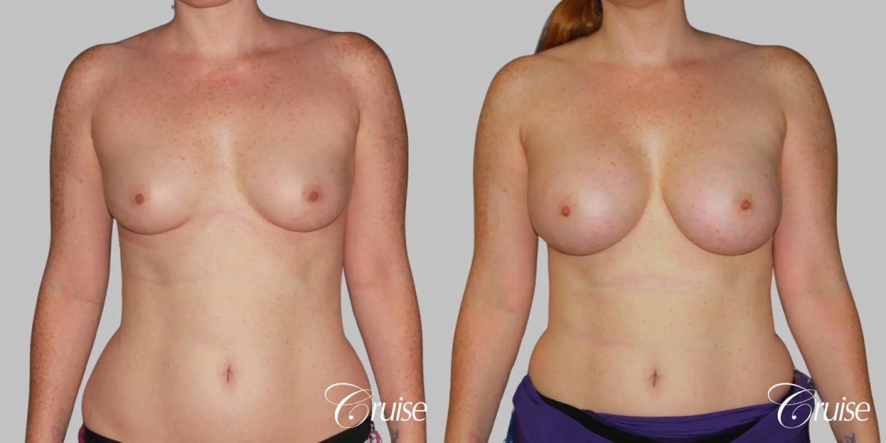 Breast Augmentation - Saline MP 375cc - Before and After 1