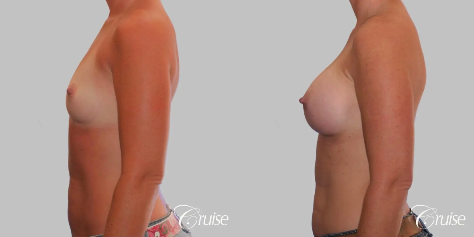 Breast Augmentation - Saline HP 370cc - Before and After 4