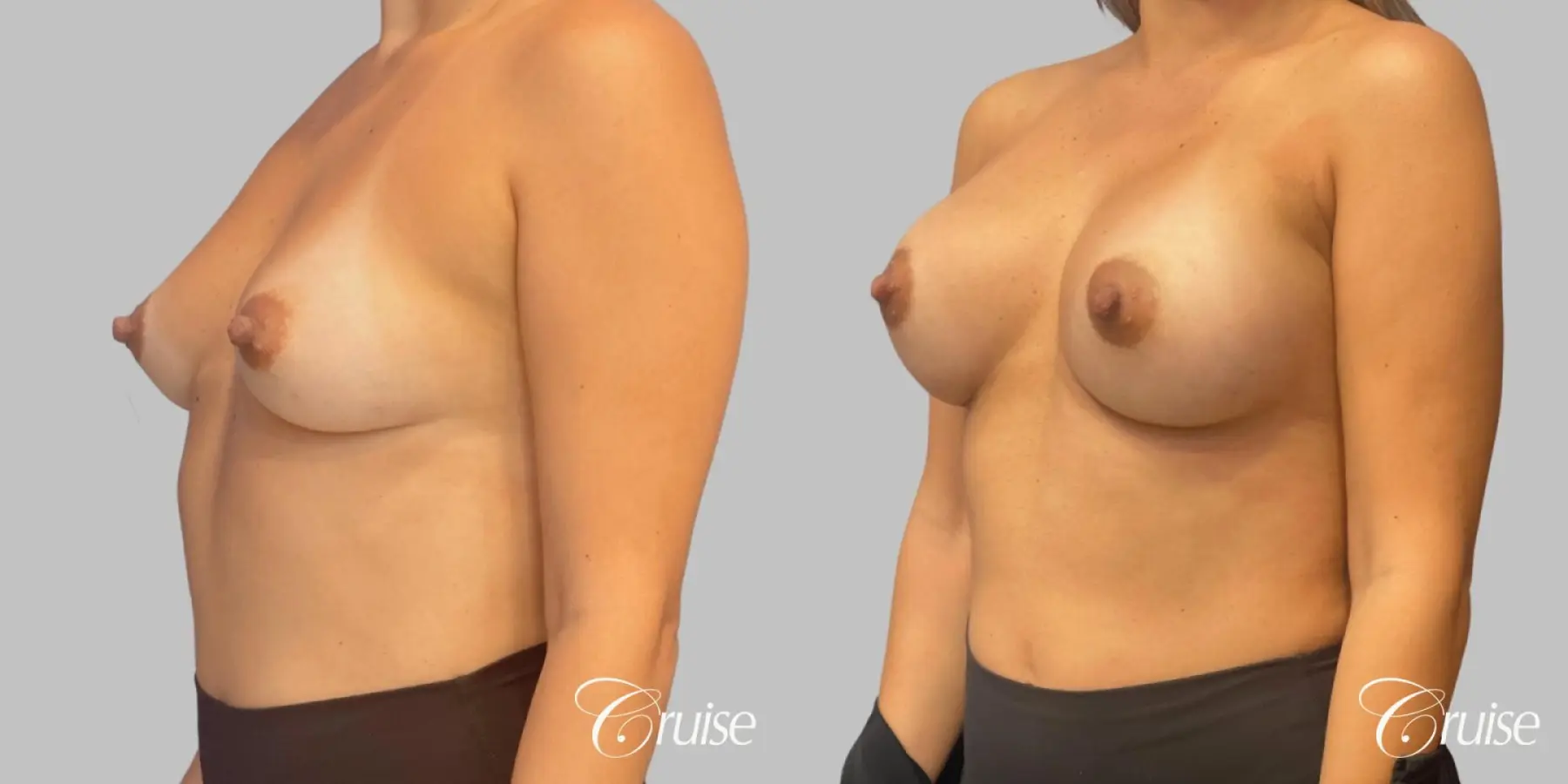 Breast Augmentation - Silicone SRM 375cc - Before and After 2