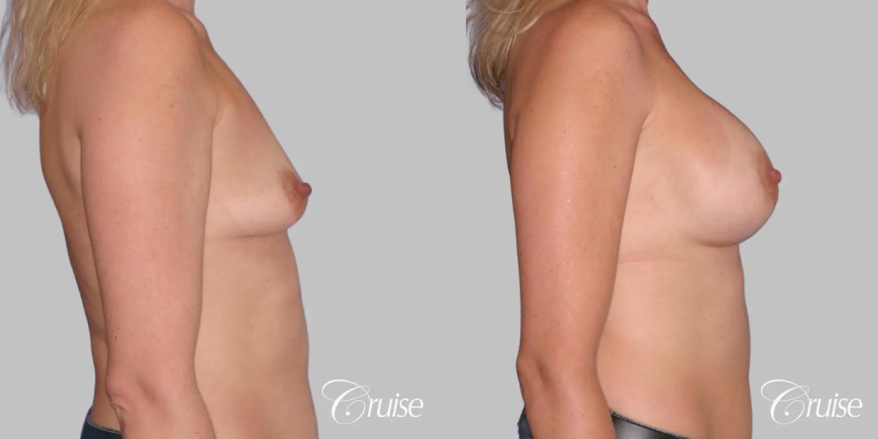 Breast Augmentation - Saline HP 470cc - Before and After 3