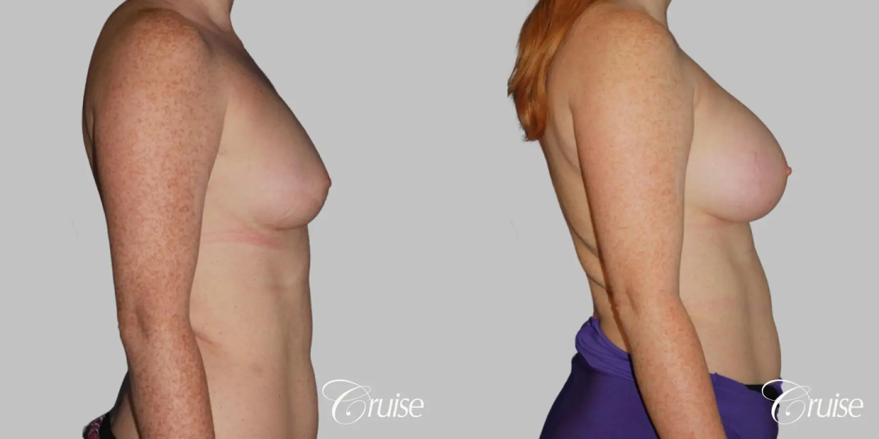 Breast Augmentation - Saline MP 375cc - Before and After 3