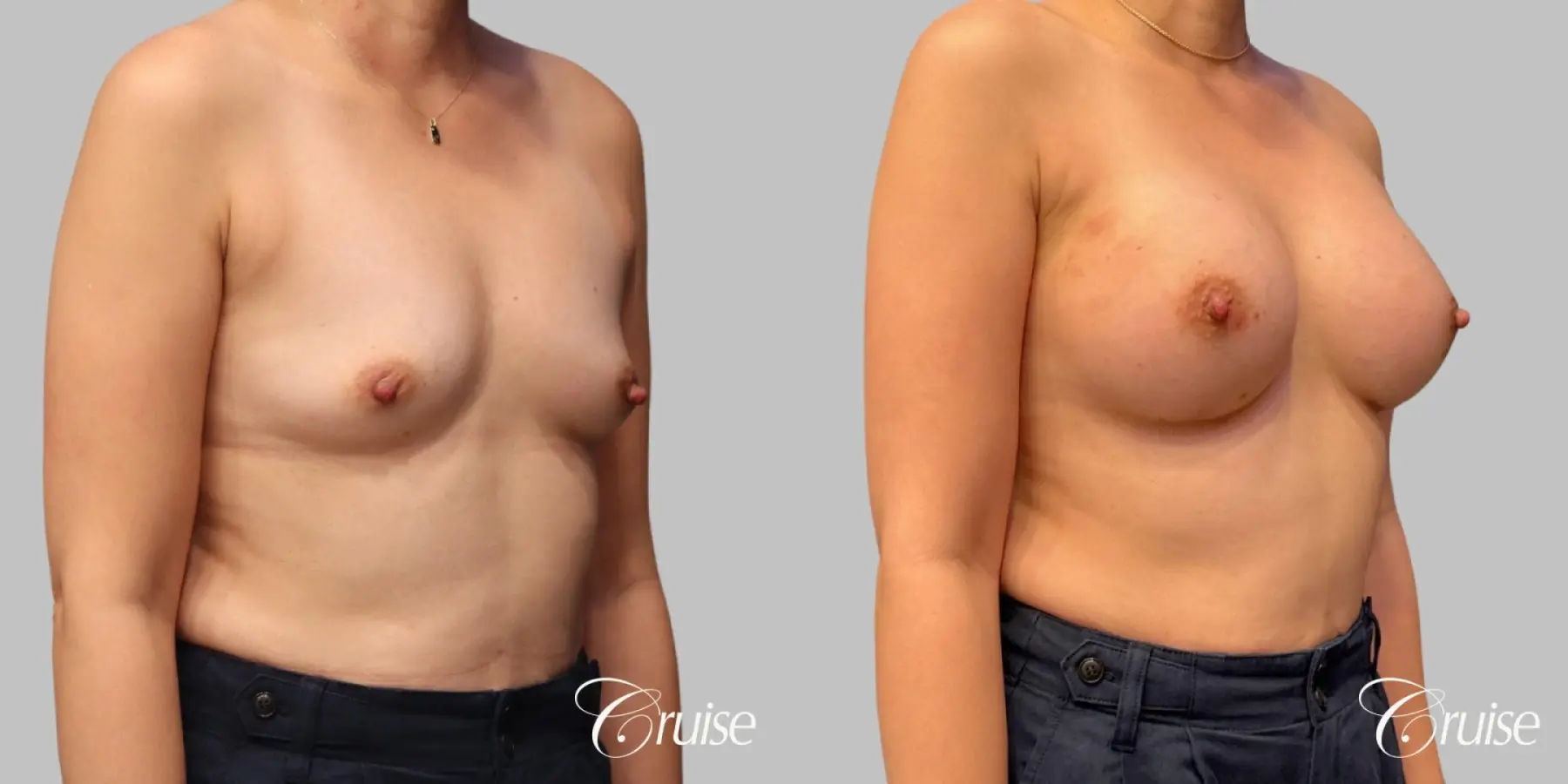 Breast Augmentation - Silicone 330cc  - Before and After 2