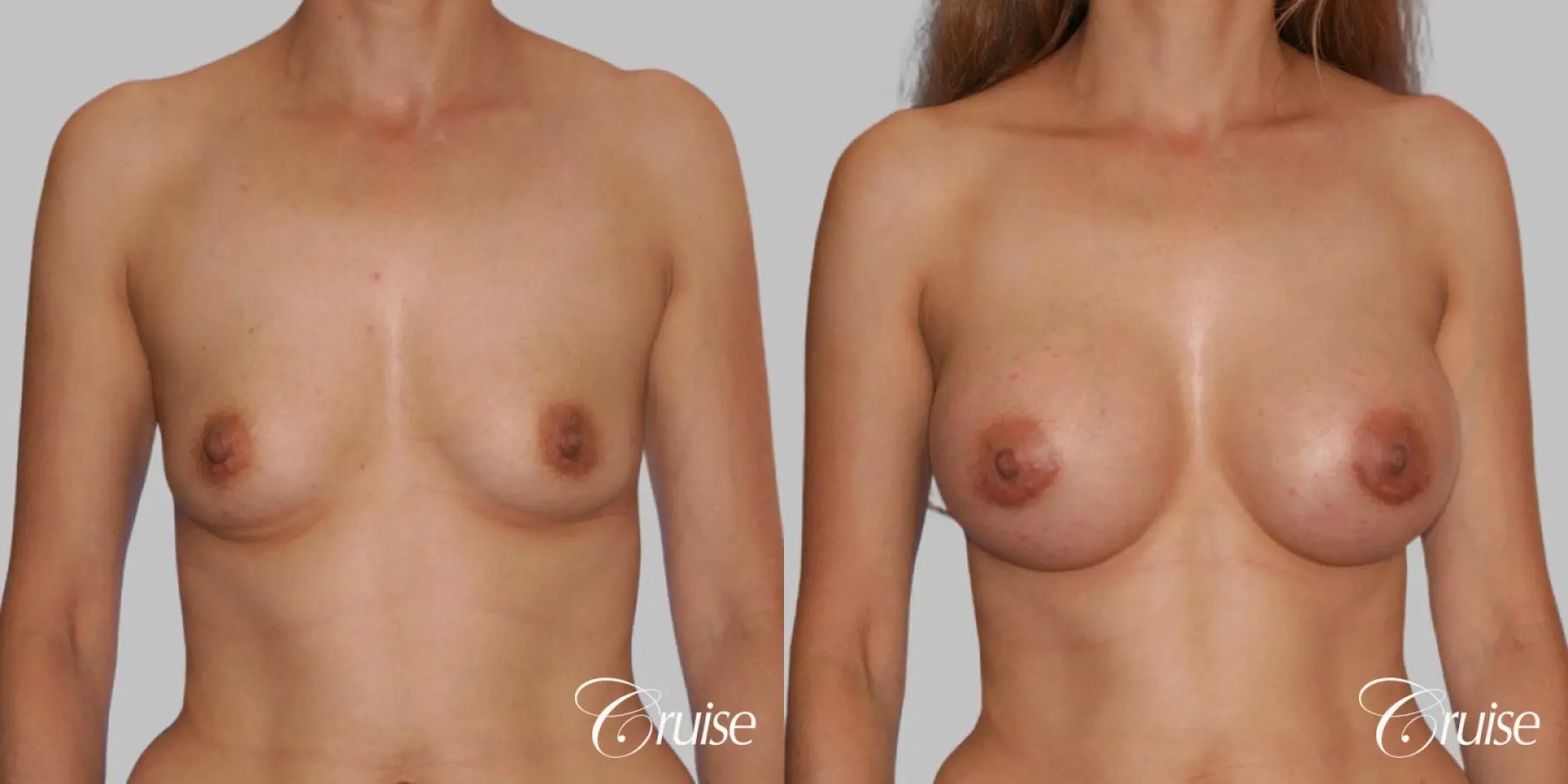 Breast Augmentation - Silicone HP 325cc - Before and After 1