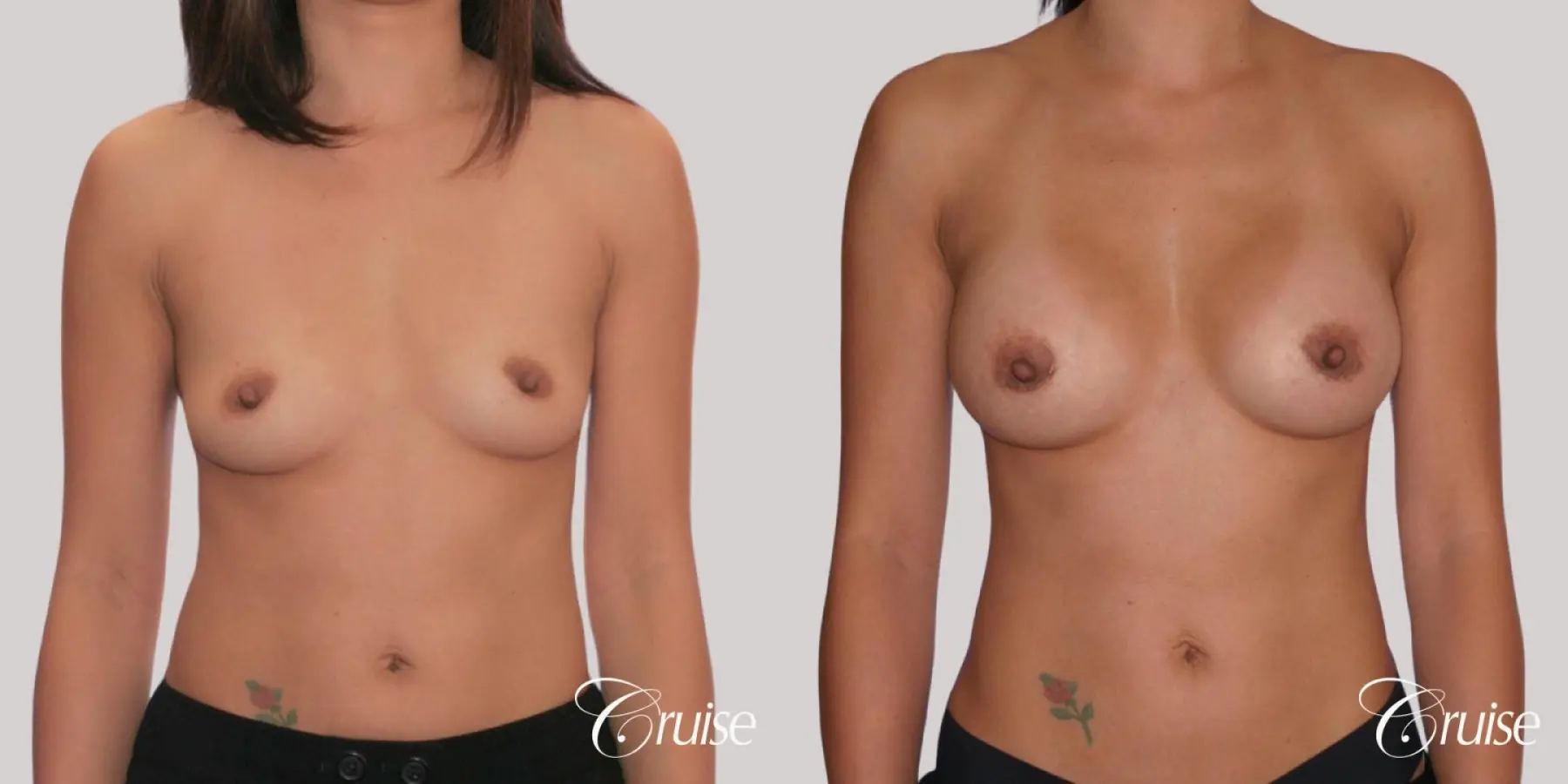 Breast Augmentation - Saline MP 255cc - Before and After  