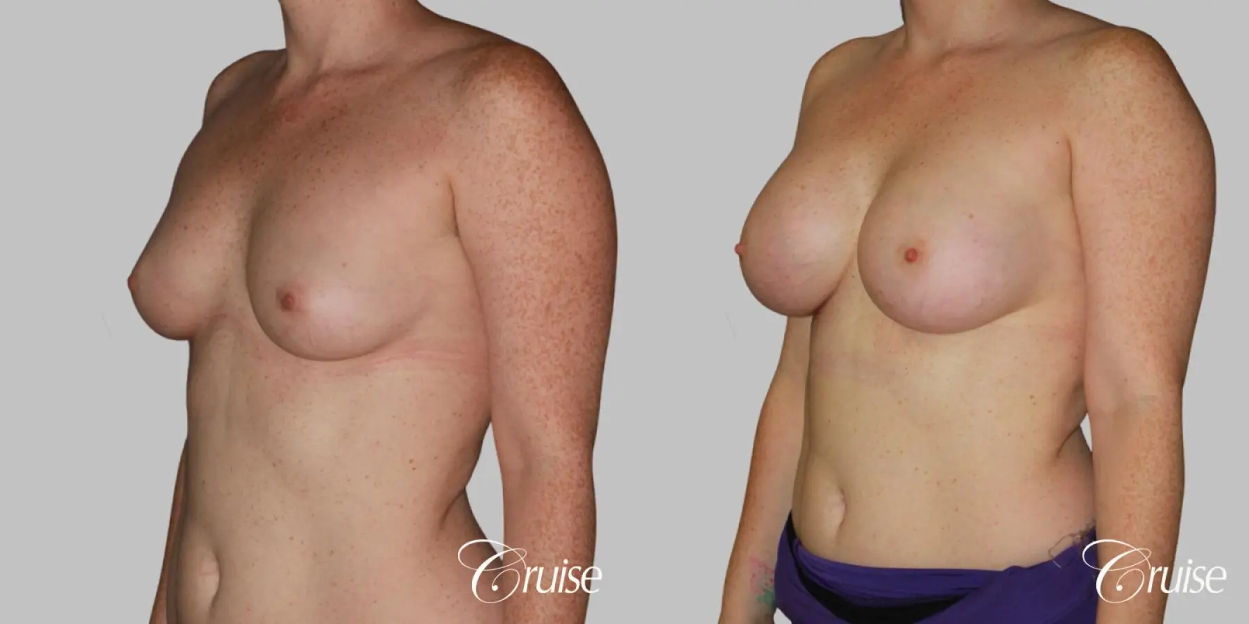 Breast Augmentation - Saline MP 375cc - Before and After 2