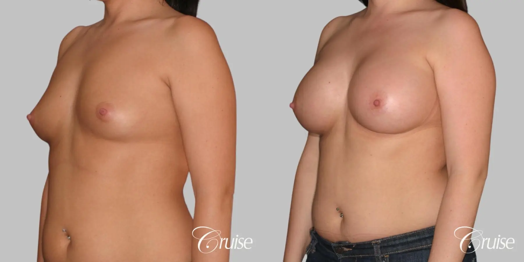 Breast Augmentation - Saline MP 375cc - Before and After 2