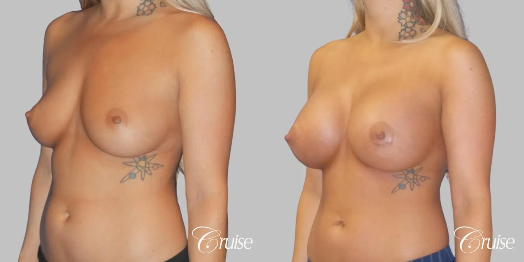 Breast Augmentation - Silicone HP 475cc - Before and After 2