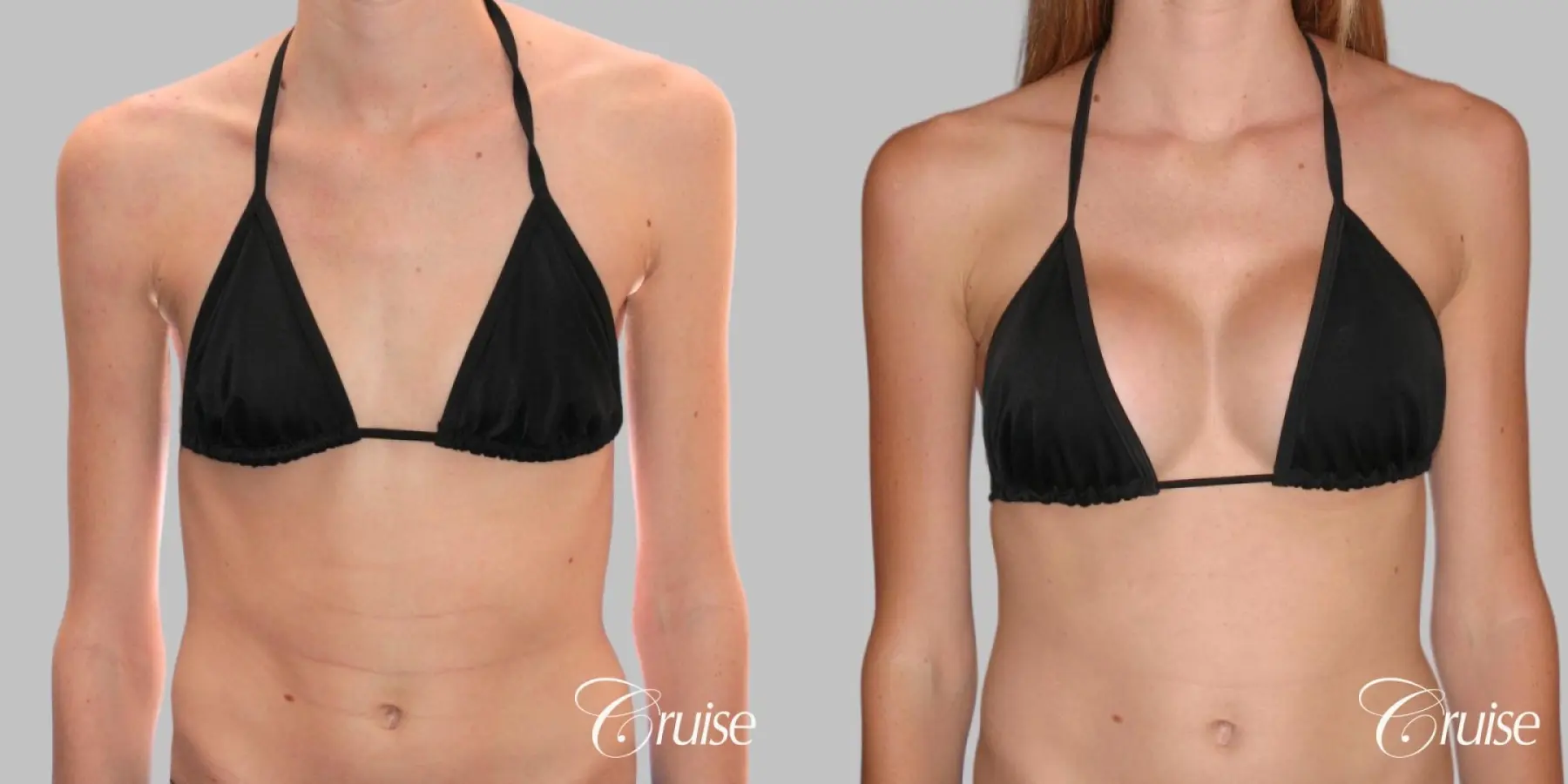 Breast Augmentation - Silicone MP 304cc - Before and After 4