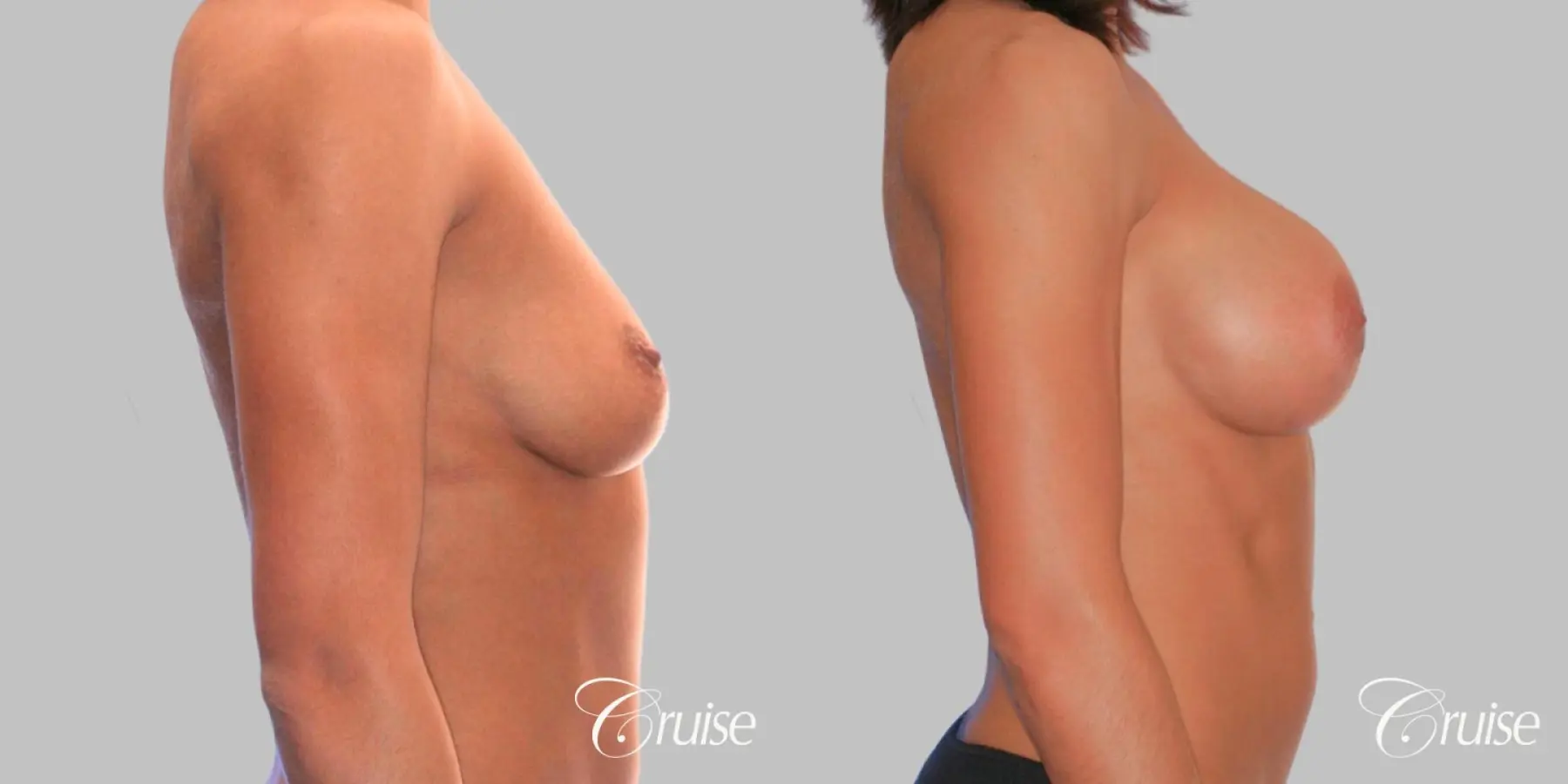 Breast Augmentation - Silicone HP 475cc - Before and After 3