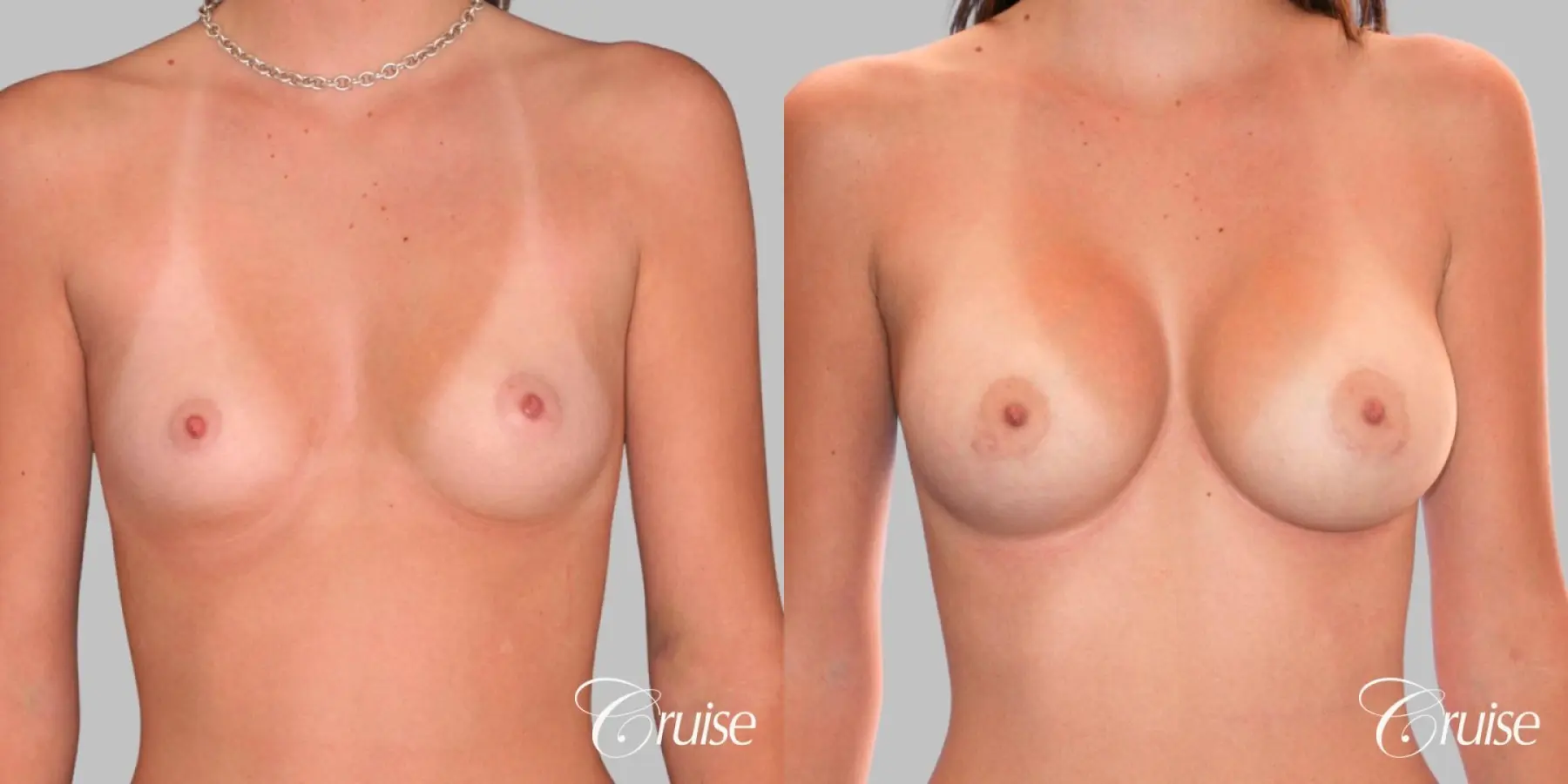 Breast Augmentation - Saline MP 360cc - Before and After  