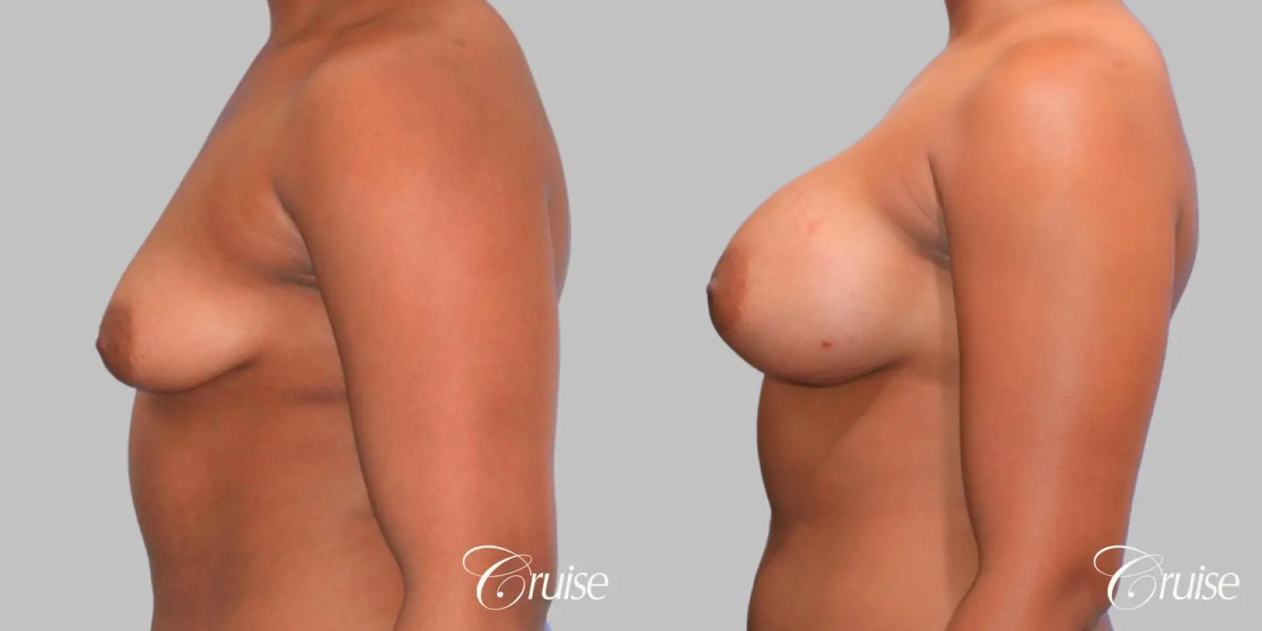 Breast Augmentation - Silicone HP 450cc - Before and After 3