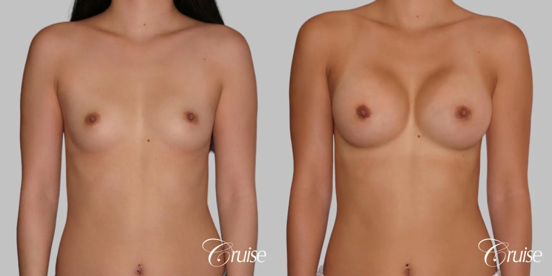 Breast Augmentation - Saline HP 280cc - Before and After 1