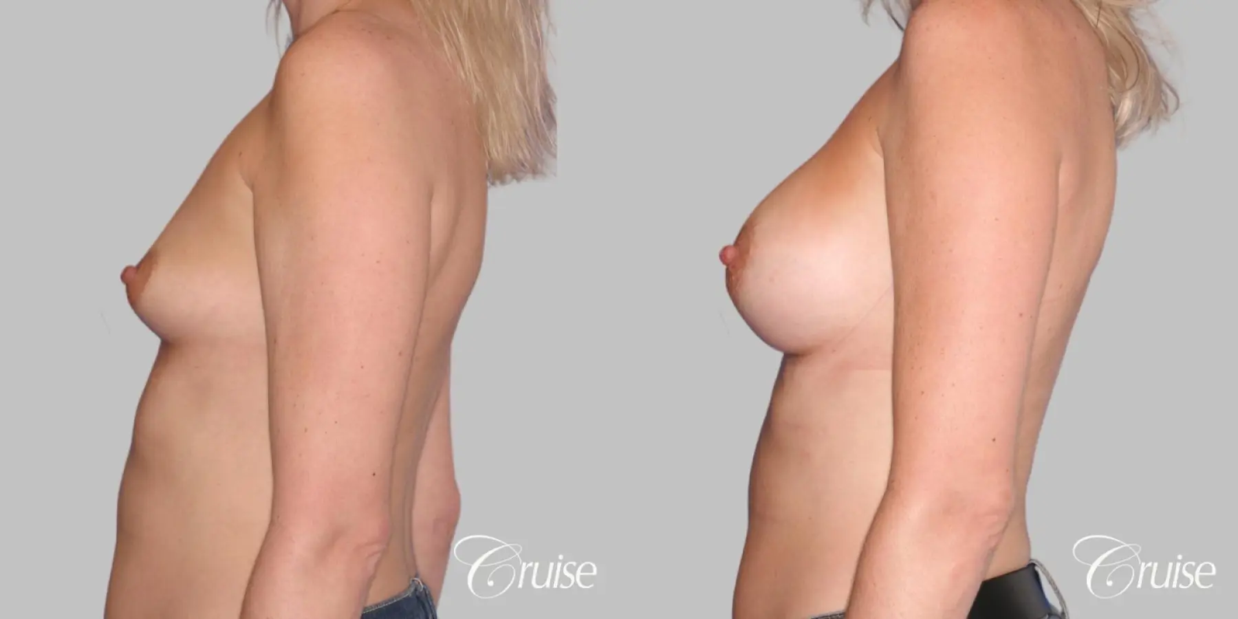 Breast Augmentation - Saline HP 470cc - Before and After 2