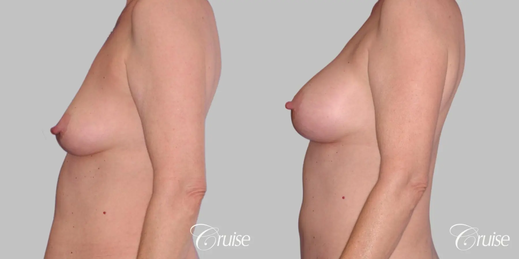 Breast Augmentation - Saline HP 450cc - Before and After 2