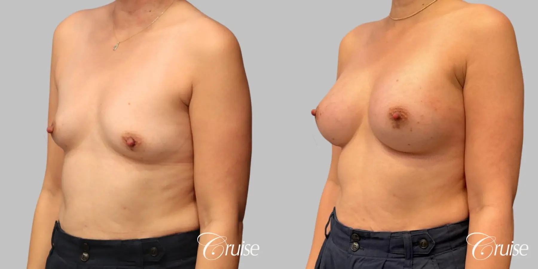 Breast Augmentation - Silicone 330cc  - Before and After 3