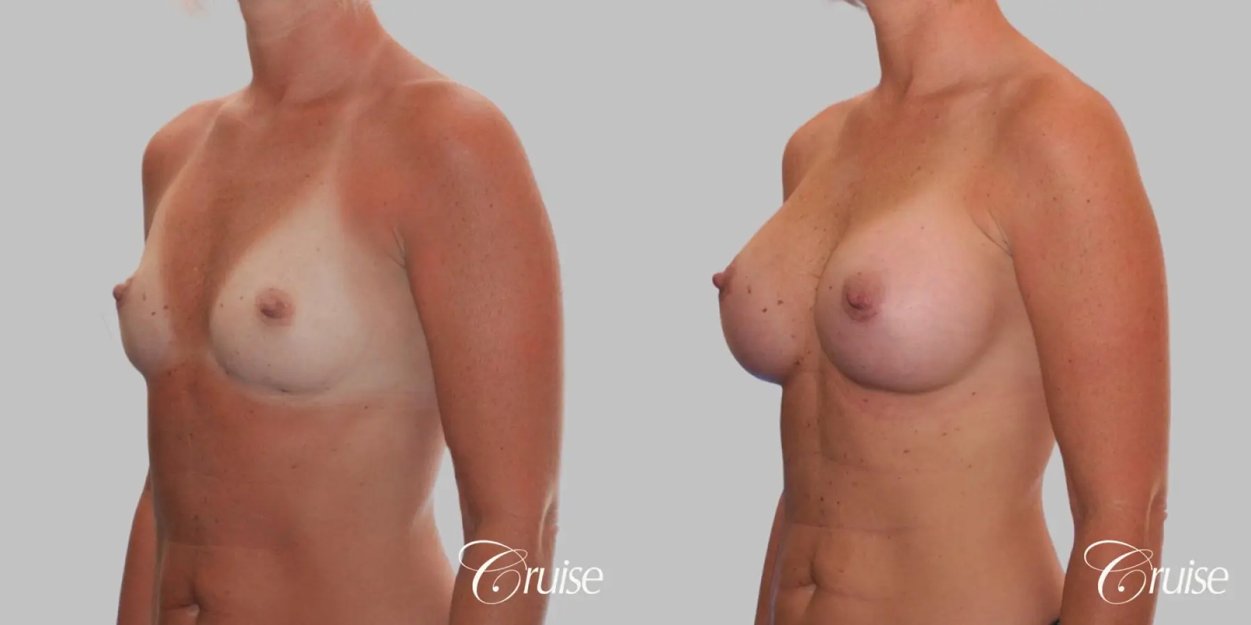 Breast Augmentation - Saline HP 370cc - Before and After 3