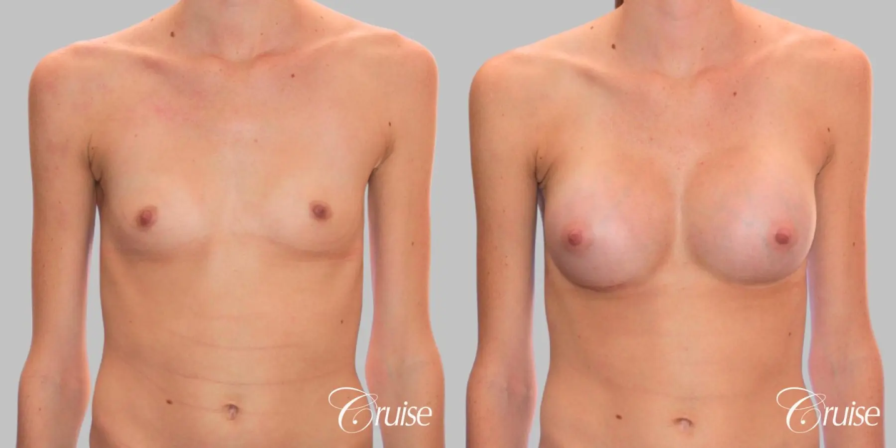 Breast Augmentation - Silicone MP 304cc - Before and After 1