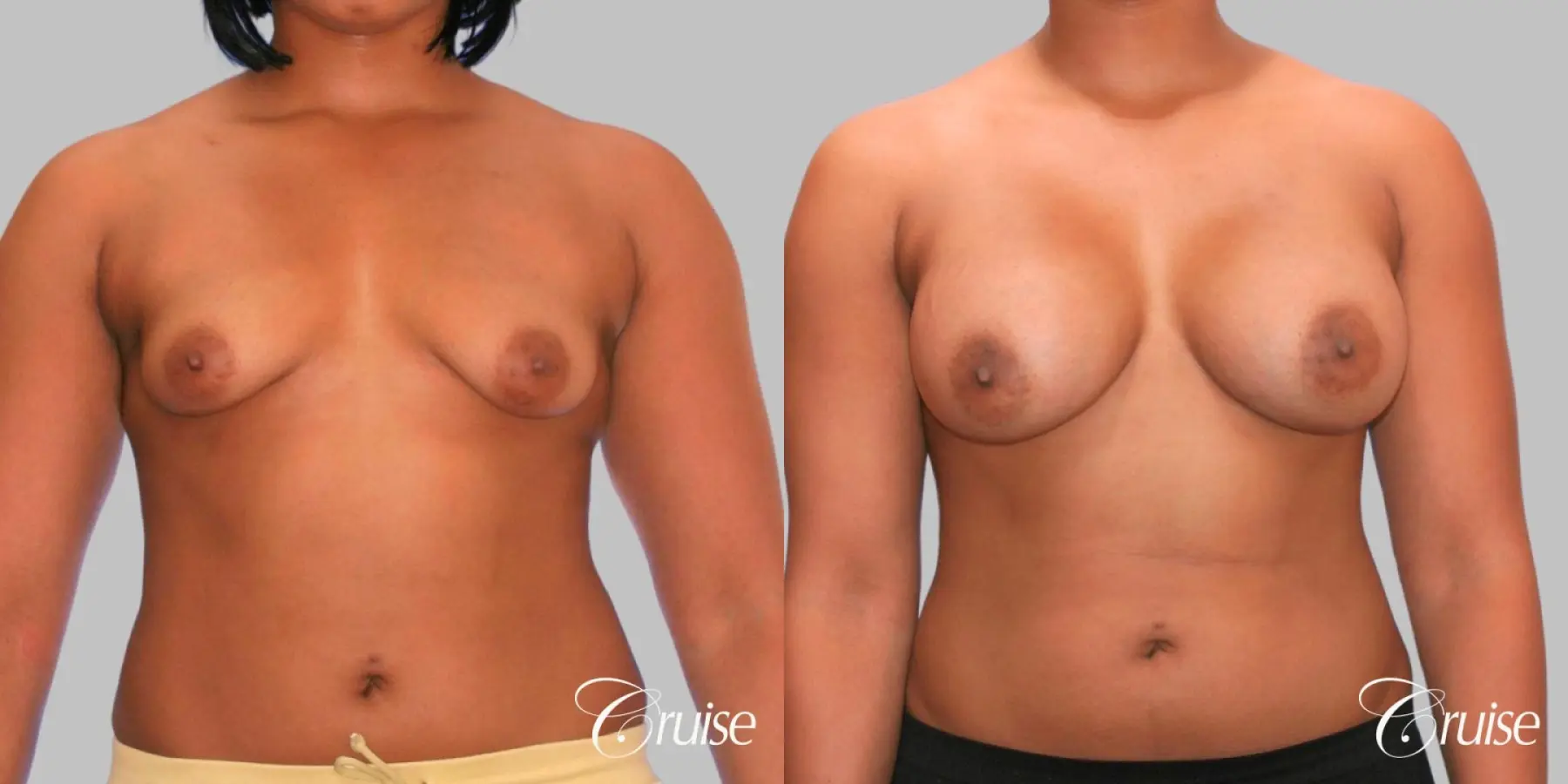 Breast Augmentation - Silicone HP 450cc - Before and After 1