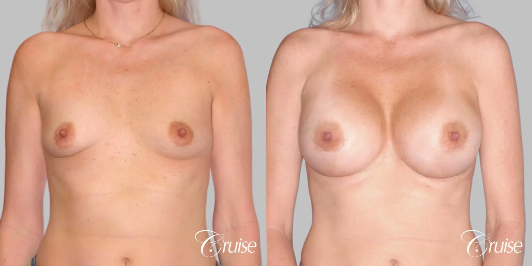 Breast Augmentation - Saline HP 470cc - Before and After 1