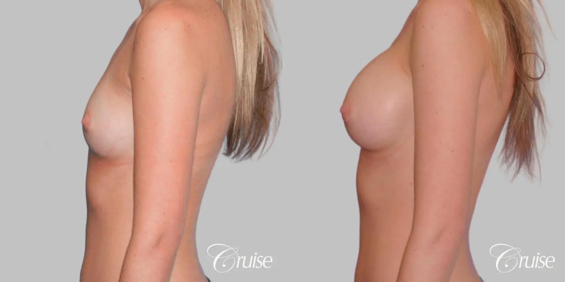 Breast Augmentation - Saline MP 440cc - Before and After 2