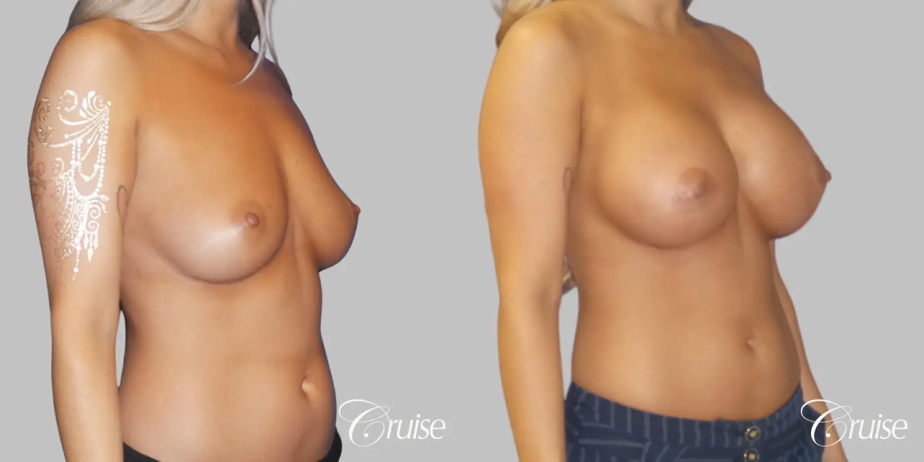 Breast Augmentation - Silicone HP 475cc - Before and After 3